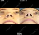 鼻尖縮小術 180日後 サムネイル用