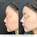 MD式プロテーゼ+鼻尖形成3D法+軟骨移植 14日後 サムネイル用