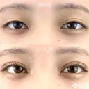 二重埋没法/まぶたの脂肪取り before画像 サムネイル用