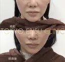 ミドルリフトプラス before画像 サムネイル用
