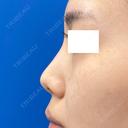 鼻中隔延長＋鼻尖形成3D＋鼻尖部軟骨移植 before画像 サムネイル用