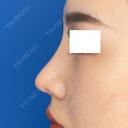 鼻中隔延長＋鼻尖形成3D＋鼻尖部軟骨移植 30日後 サムネイル用