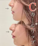 Cカールリップ 0日後 サムネイル用