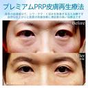 【40代女性・目の下のクマ】プレミアムPRP皮膚再生療法（13年後） before画像 サムネイル用