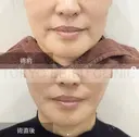 ミドルリフト after画像 サムネイル用