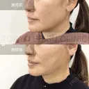 ミドルリフト after画像 サムネイル用