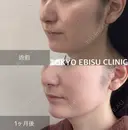 ミドルリフト after画像 サムネイル用
