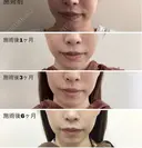 トータルフェイスリフト 180日後 サムネイル用