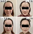 トータルフェイスリフト、人中短縮、口角挙上、ヒアルロン酸のコメカミ・あご after画像 サムネイル用