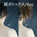 肩ボトックス(６㏄) after画像 サムネイル用