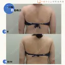 二の腕、肩、付け根の脂肪吸引 90日後 サムネイル用