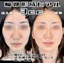輪郭形成ヒアルロン酸(ドールチーク/貴族フィラー/アゴ) before画像 サムネイル用