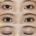 優しい目元に😌フォーエバーブリリアント埋没法 7日後 サムネイル用