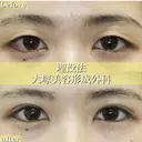 愛され目元の二重術💗 after画像 サムネイル用