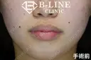 【口唇縮小手術上下】 before画像 サムネイル用