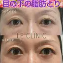 目の下の脂肪取り before画像 サムネイル用