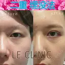 二重埋没法 after画像 サムネイル用