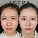 隆鼻術/鼻尖形成/軟骨移植/小鼻縮小 before画像 サムネイル用