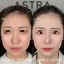 隆鼻術/鼻尖形成/軟骨移植/小鼻縮小 after画像 サムネイル用