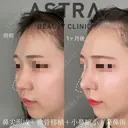 隆鼻術/鼻尖形成/軟骨移植/小鼻縮小 after画像 サムネイル用