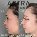隆鼻術/鼻尖形成/軟骨移植/小鼻縮小 after画像 サムネイル用