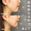 脂肪吸引注射｜あご下 before画像 サムネイル用