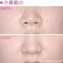 小鼻縮小 after画像 サムネイル用