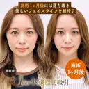 1day小顔®︎脂肪吸引（脂肪吸引（顔）＋糸リフト） before画像 サムネイル用
