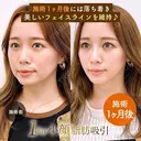1day小顔®︎脂肪吸引（脂肪吸引（顔）＋糸リフト） 30日後 サムネイル用
