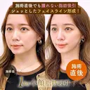 1day小顔®︎脂肪吸引（脂肪吸引（顔）＋糸リフト） after画像 サムネイル用