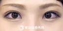 埋没二重(4点留め) after画像 サムネイル用