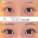 タレ目＋目尻切開 30日後 サムネイル用