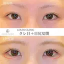タレ目＋目尻切開 before画像 サムネイル用