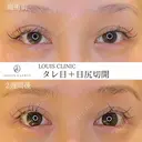 タレ目（埋没）+目尻切開 14日後 サムネイル用
