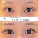 タレ目＋目尻切開 before画像 サムネイル用