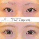 タレ目＋目尻切開 after画像 サムネイル用