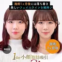 1day小顔®︎脂肪吸引（脂肪吸引（顔）＋糸リフト） 30日後 サムネイル用