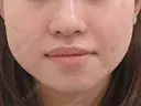 鼻翼縮小術（内側法）+　鼻孔縁挙上術 before画像 サムネイル用