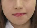鼻翼縮小術（内側法）+　鼻孔縁挙上術 after画像 サムネイル用