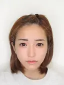 TAC式ツヤ肌コラーゲンリフト+バッカルファット除去 after画像 サムネイル用