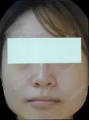 鼻翼縮小（外側） before画像 サムネイル用