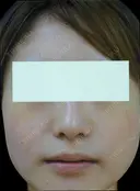 鼻翼縮小（外側） after画像 サムネイル用