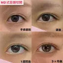 理想の目元になる😍目頭切開 90日後 サムネイル用
