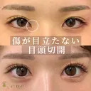 韓流目頭切開 after画像 サムネイル用