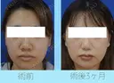 鼻尖縮小・鼻翼縮小（外側法） after画像 サムネイル用