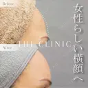 女性らしい横顔へ｜額の脂肪注入 before画像 サムネイル用