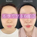 ルラリフト6部位 after画像 サムネイル用
