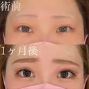 グラマラスライン切開 before画像 サムネイル用