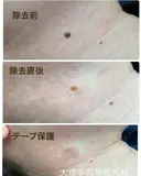 気になる"ほくろ"撃退👊ほくろ除去/CO2レーザー after画像 サムネイル用