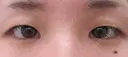 全切開法二重術＋目頭切開 before画像 サムネイル用